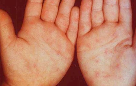 BABIO Launches EV71-IgM Rapid Detection Kit for Early Diagnosis