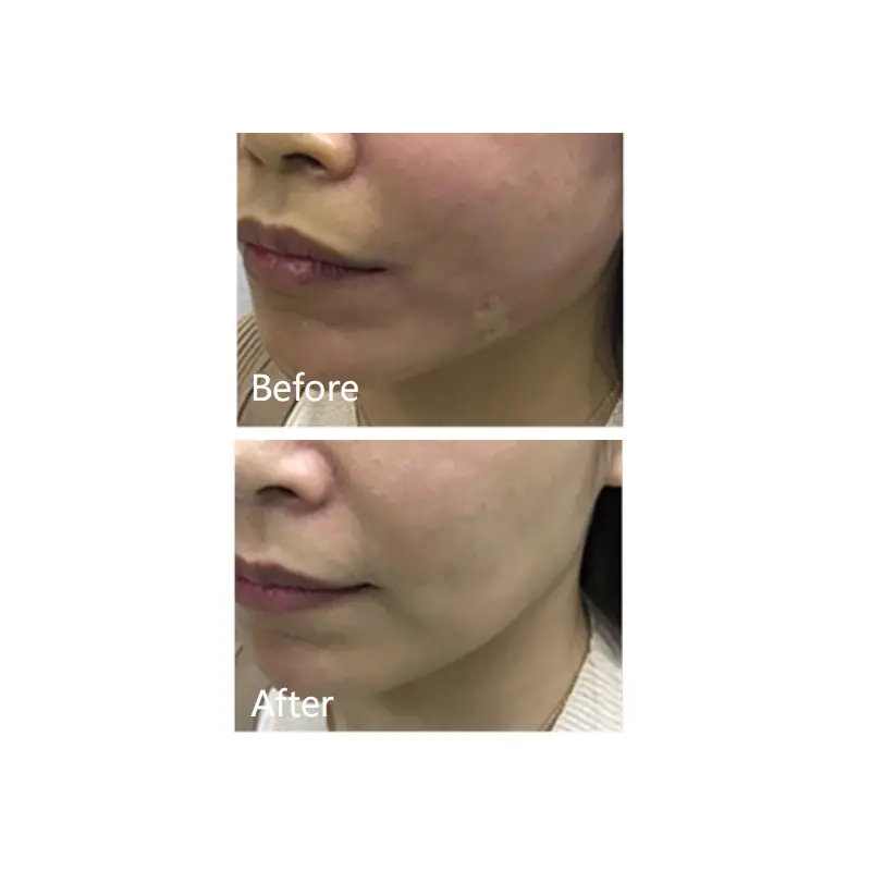 Meso Hyaluronic Acid