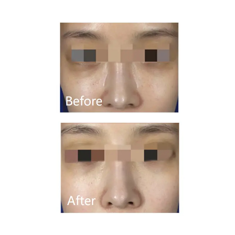 Meso Antienvejecimiento