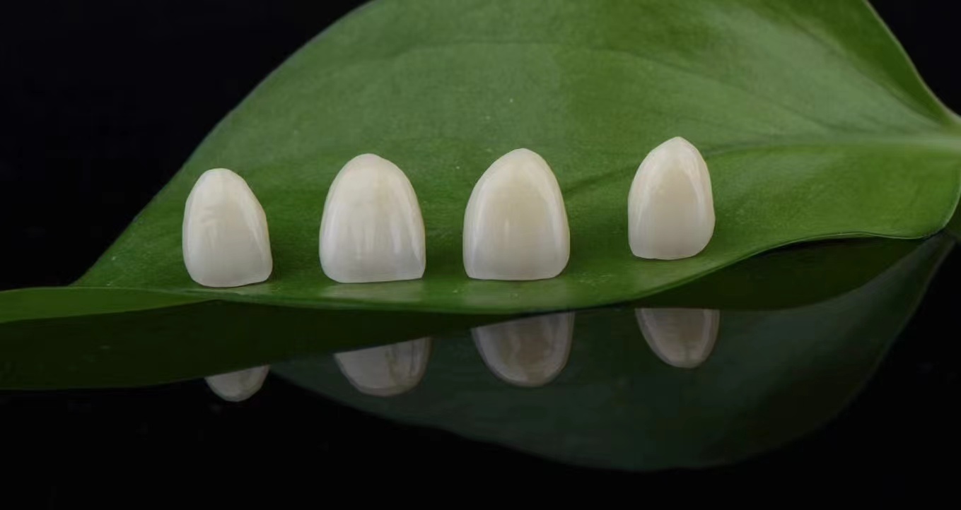 Veneers