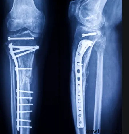 Avances en la investigación de la modificación de la superficie de la aleación de titanio biomédico para mejorar la resistencia al desgaste