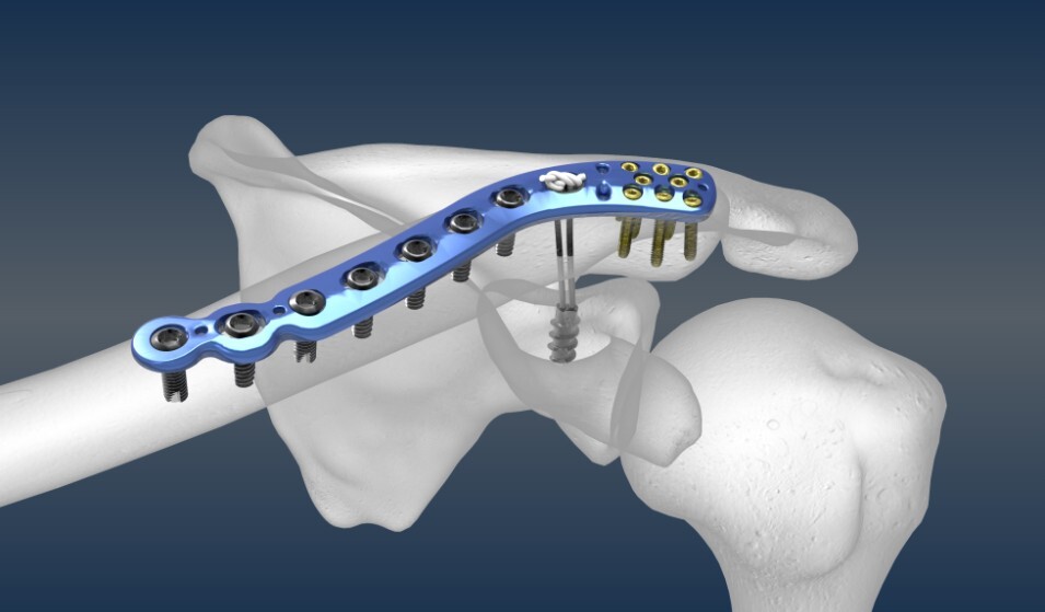 Bone Screw & Bone Plate Bone Screw & Bone Plate